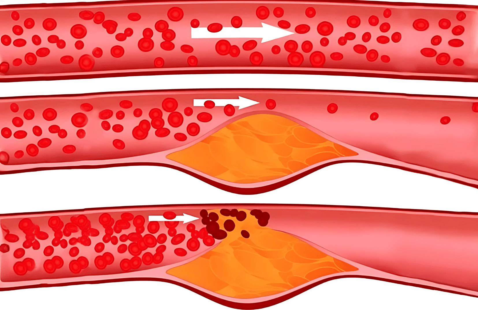 Illustration of the erection process